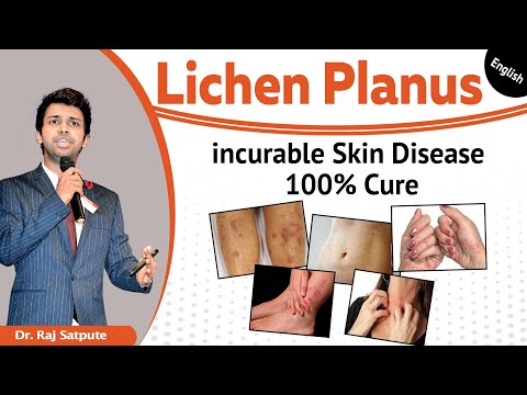 *Lichen Planus Skin Disease 100% Results From The First Week*