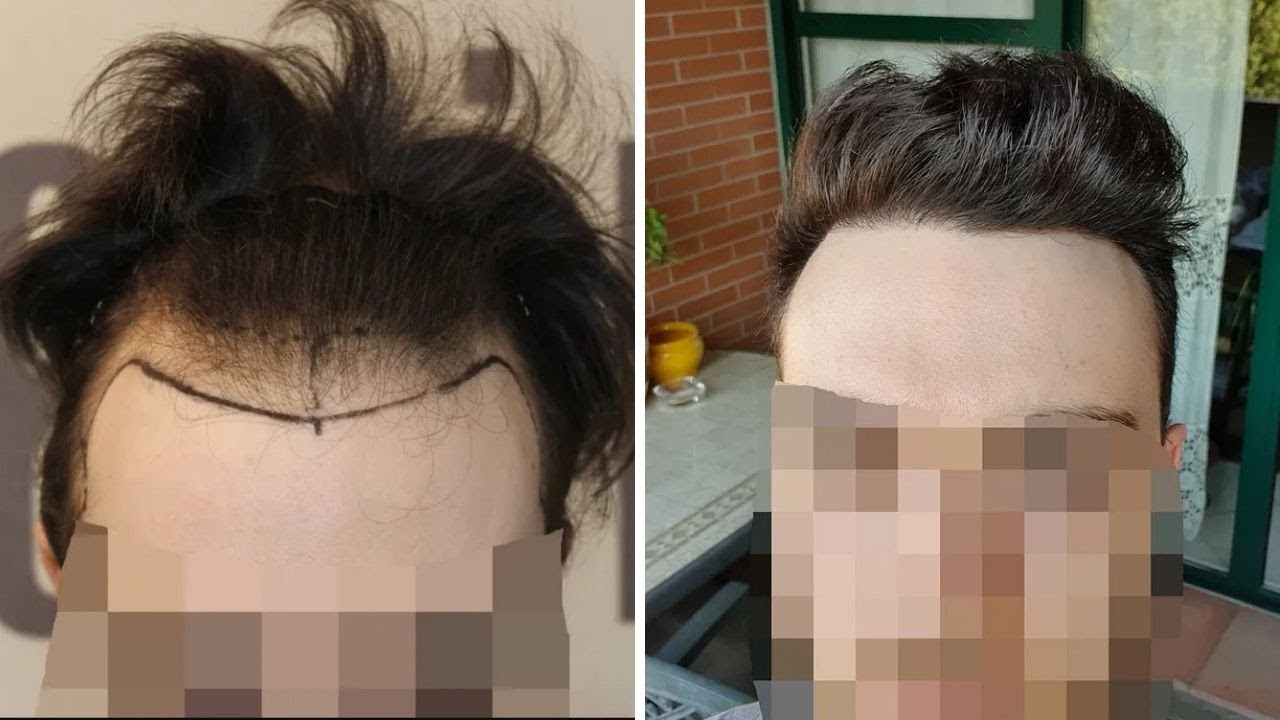 Dr.Kaan Pekiner 2704 grafts FUE - 3 anni dopo 