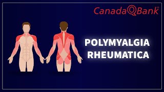 Polymyalgia Rheumatica