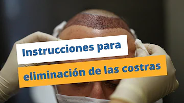 ¿Cómo se eliminan las costras a los 14 días del trasplante capilar?