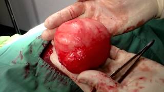 Lipoma / Fat Tumor in a dog - Surry Hills Vet(, 2013-11-13T11:23:54.000Z)