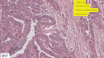Papillary thyroid carcinoma microscopy - Talking slide