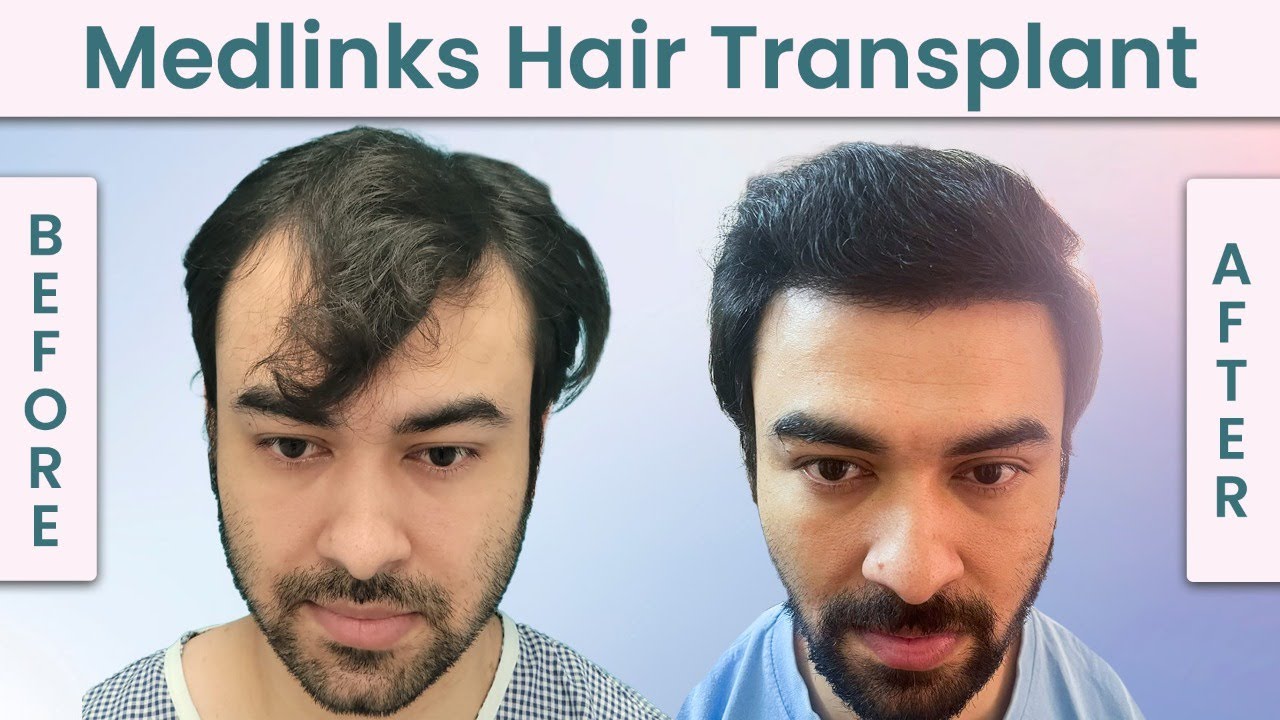 Best Hair Transplant in Delhi India at the Best Hair Clinic in Delhi   MedRootz