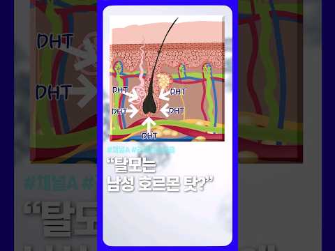 탈모는 호르몬 탓일까? / #채널A #shorts