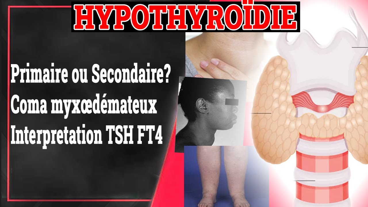 HYPOTHYROÏDIE : Primaire ou Secondaire? Biologie, Traitement... | Endocrinologie Medicale