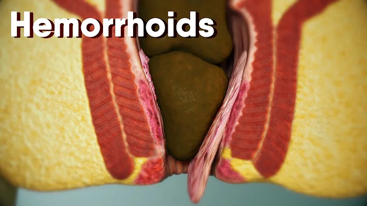 Hemorrhoids|different types of hemorrhoids| internal and external Hemorrhoids| Hemorrhoids treatment - DayDayNews