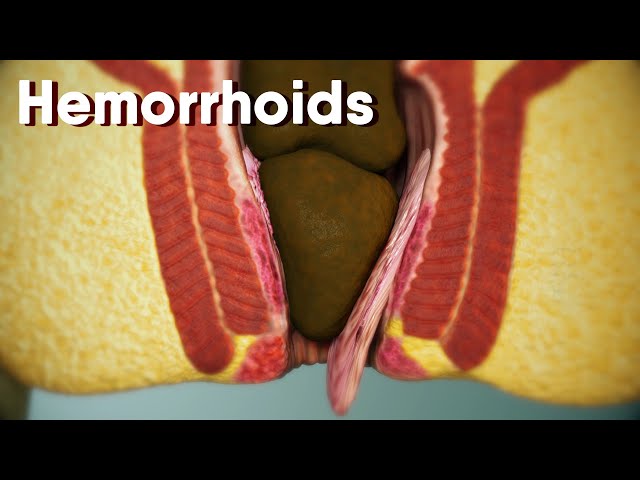Hemorrhoids|different types of hemorrhoids| internal and external  Hemorrhoids| Hemorrhoids treatment