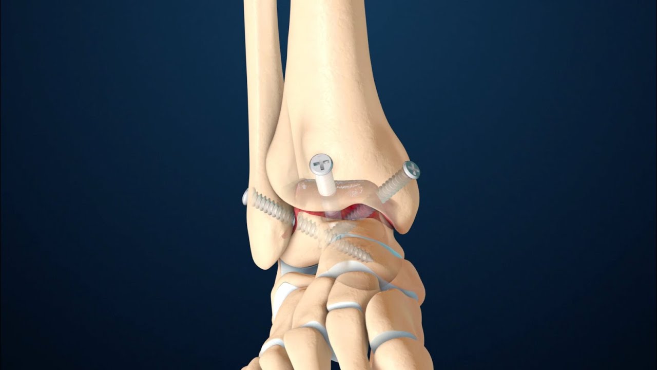 Fusión de Tobillo Anterior