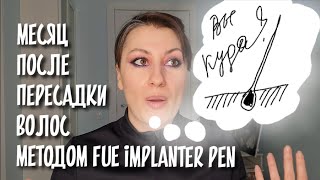 АЛОПЕЦИЯ| 1 месяц после пересадки волос методом FUE Implanter Pen в Спб | шоковое выпадение и зуд