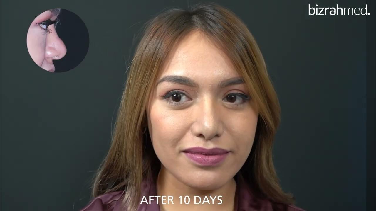 Rhinoplasty before and after Rhinoplasty testimonials YouTube