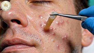 [ASMR] Ultra realistic deep blackhead removal ✨ Dr. Lee’s spa facial for smooth, sleep sideways 667