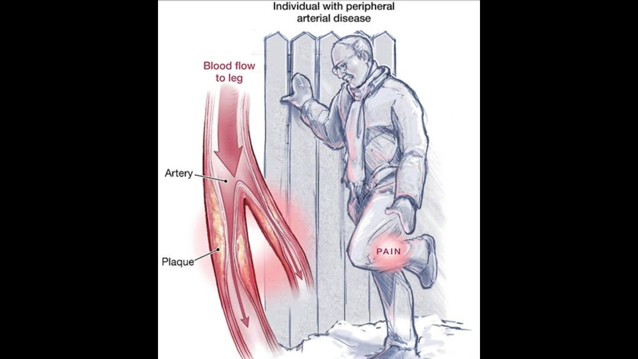 kullo rooke peripheral artery disease