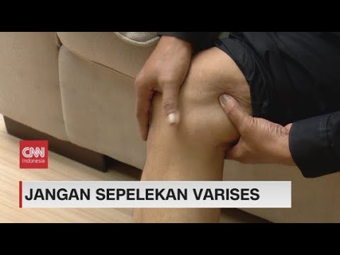 Video: Bisakah varises menyebabkan nyeri lutut?