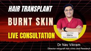 Hair Transplant on Burnt Skin | Live Consultation with Female Patient | NeoGraft Chandigarh