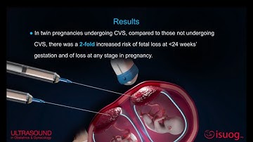 #UOG video abstract on chorionic villus sampling in twin pregnancy