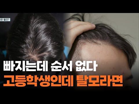 어리다고 방심하면 순식간... 미성년자도 탈모 약 먹어도 되나요?｜#귀하신몸
