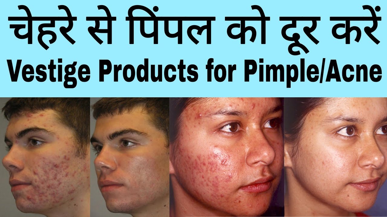Vestige Products For Acne Pimple Vestige Skin Care Products YouTube vestige-products-for-acne-pimple-vestige-skin-care-products-youtube