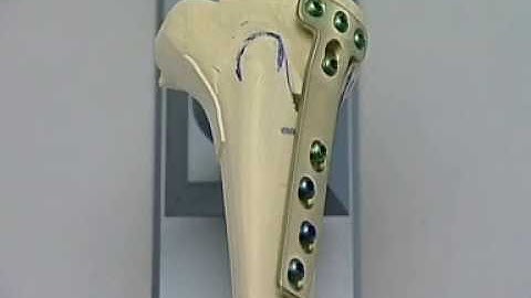 High Tibia Valgisation Osteotomy HTO Open wedge With The Tomofix System