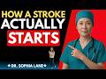 What a Stroke Looks Like the Day Before It Hits — Know This to Protect Yourself }Dr. Sophia Lane
