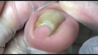 Very curved nail treatment