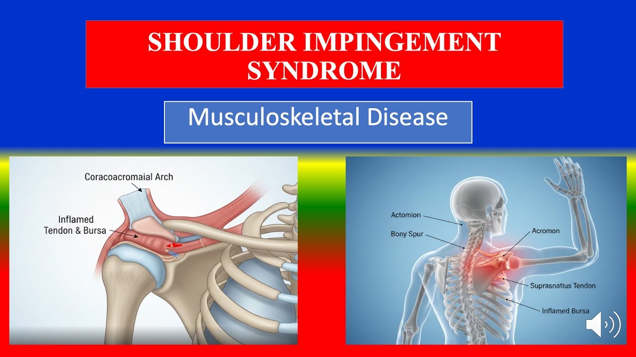 Синдром импинджмента плечевого сустава - Определение, виды, причины, патоморфология, симптомы, ди...