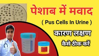 Pus Cells In Urine ! Causes Of Pus cells In Urine ! Pus Cells ! Urine Test,urine infection,पेशाब में