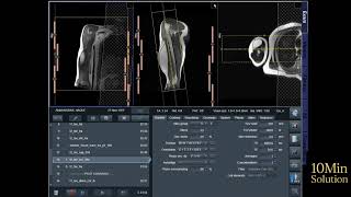  MRI of Rt Arm Planning Protocol Siemens 3t 