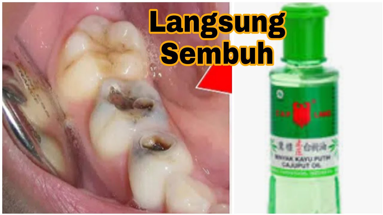 3 Cara Mengobati Sakit Gigi dan Gusi Bengkak YouTube