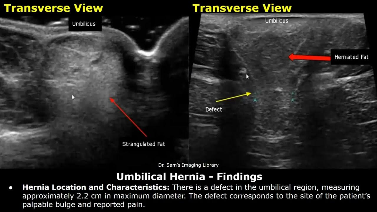 Umbilical hernia, Radiology Case