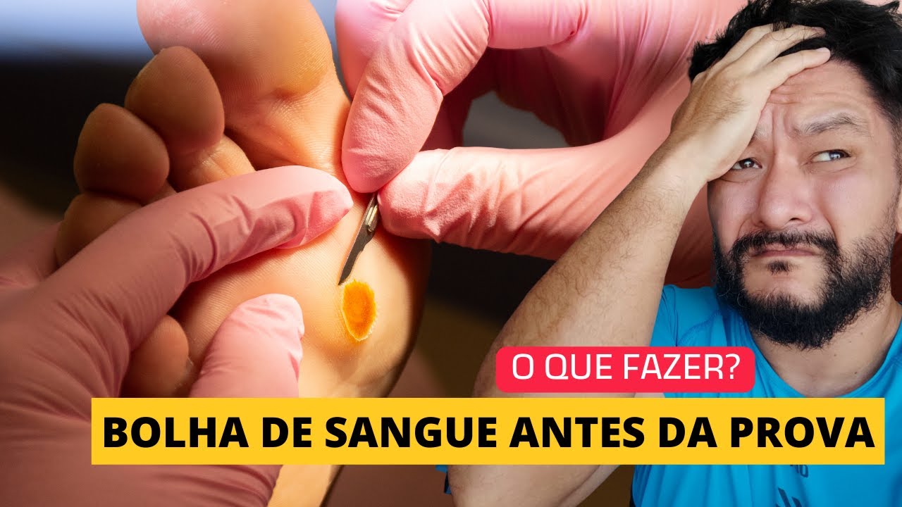 Bolha de sangue na semana da prova - YouTube