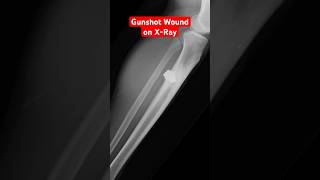 Gunshot Wound on X-Ray #shorts #xray #radiology #trauma