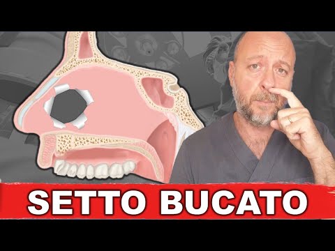 Video: Quanto è comune la perforazione del setto?