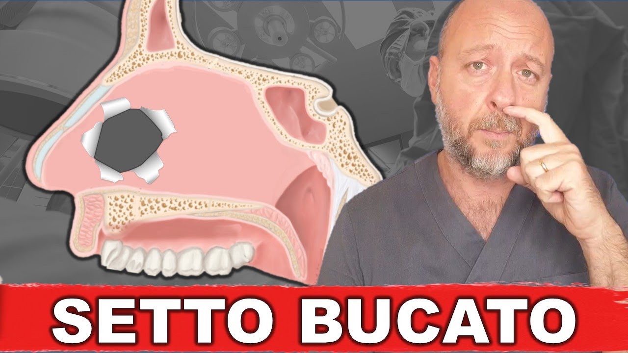 Setto nasale perforato dopo intervento di settoplastica un caso estremo! YouTube Setto nasale perforato dopo intervento di settoplastica un caso estremo! YouTube