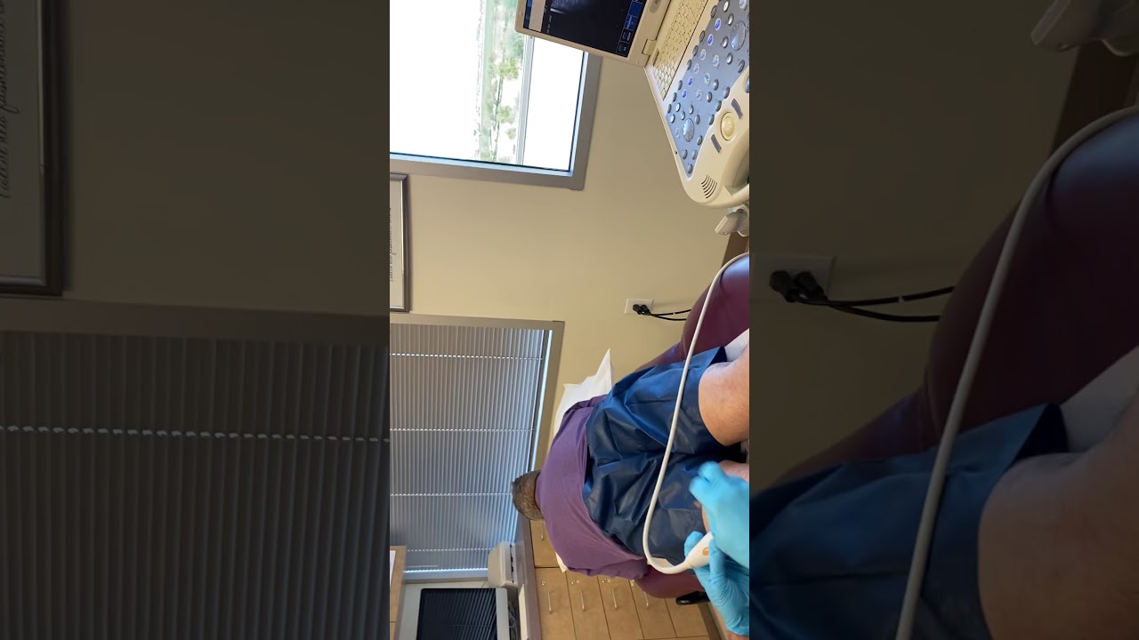 ULTRASOUND GUIDED SCLEROTHERAPY of a POPLITEAL FOSSA PERFORATOR