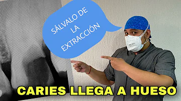 ¿Es frecuente que aparezca una caries bajo una corona?