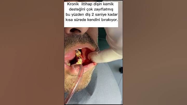 Kronik iltihaplı dişin 2 saniyede çekimi  //Tooth extraction in 2 seconds.  #asmr