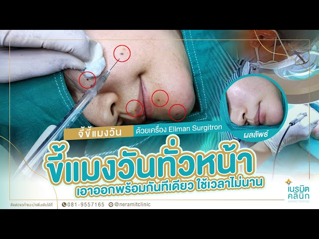 รีวิวตัดไฝ ขี้แมลงวัน EP.164/จี้ขี้แมลงวันทั่วหน้า ใช้เวลาไม่นาน @หมอปุ๊ NeramitClinic