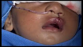 Cleft lip repair under sedation & infraorbital block: Day-care