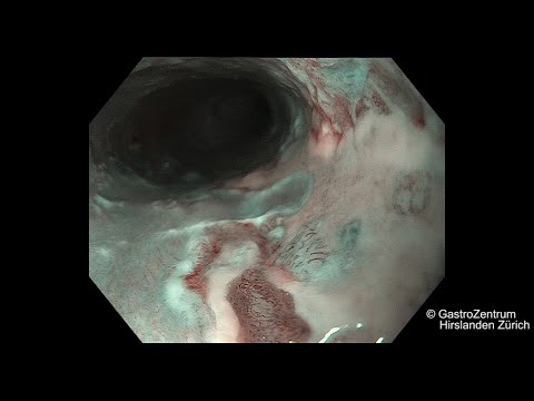 terapia para el cáncer de próstata icd 10