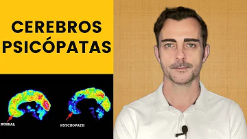 ¿Qué parte del cerebro causa los psicópatas?