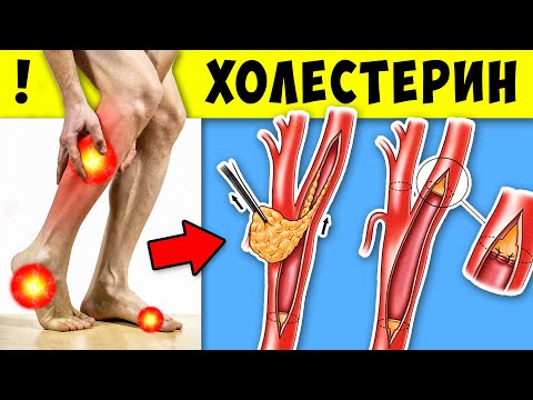 Как распознать Повышенный уровень Холестерина? Как снизить Холестерин. Как распознать Повышенный уровень Холестерина? Как снизить Холестерин.
