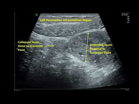 Bowel Adhesion Causing