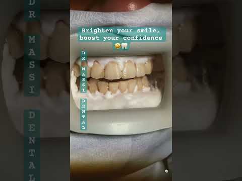 Brighten Your Smile Boost Your Confidence 