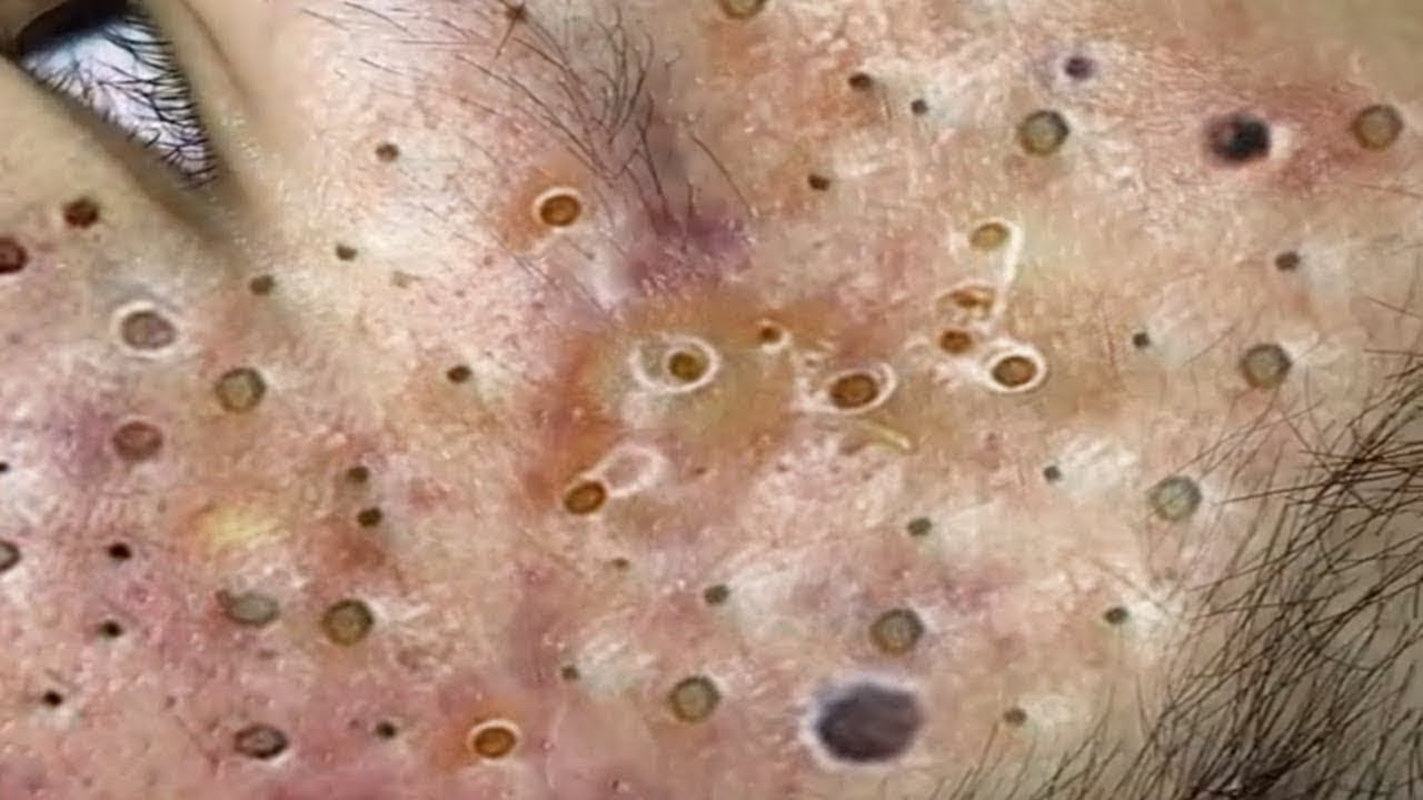 The World's Best Acne Treatment for Clear Skin 