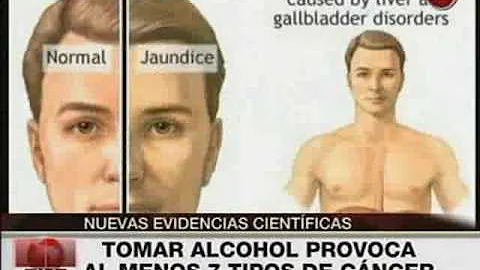 ¿Qué tipos de cáncer provoca el alcohol?