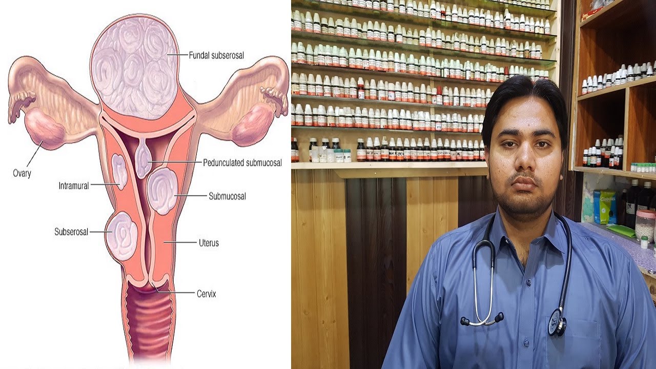 6 Best Homeopathic Medicines for Uterine Fibroids Treatment YouTube