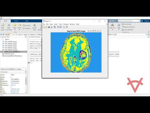 PARALLEL ANT COLONY OPTIMIZATION SYSTEM FOR MAGNETIC RESONANCE IMAGEMRI TO DETECT BRAIN TUMOR