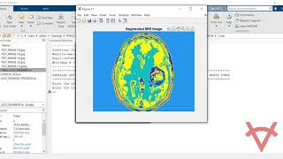 PARALLEL ANT COLONY OPTIMIZATION SYSTEM FOR MAGNETIC RESONANCE IMAGEMRI TO DETECT BRAIN TUMOR