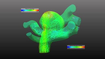 Blood Flow Simulation in Intracranial Aneurysm (Blood velocity) with MEDVIS 3D