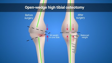 Over-corrected misalignment associated with poorer outcomes after open-wedge high tibial osteotomy
